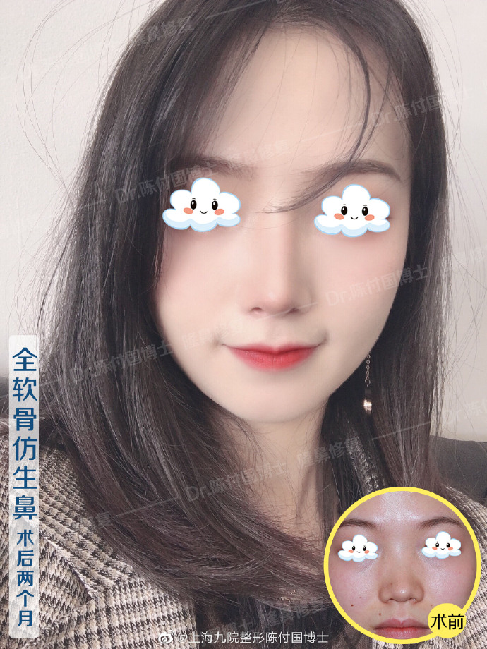 陳付國(guó)鼻綜合案例