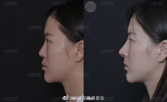 劉彥軍鼻綜合