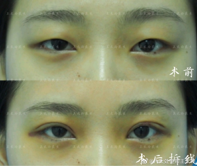 王太玲雙眼皮案例