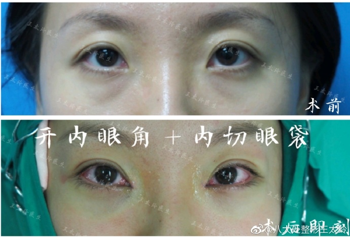 王太玲雙眼皮案例