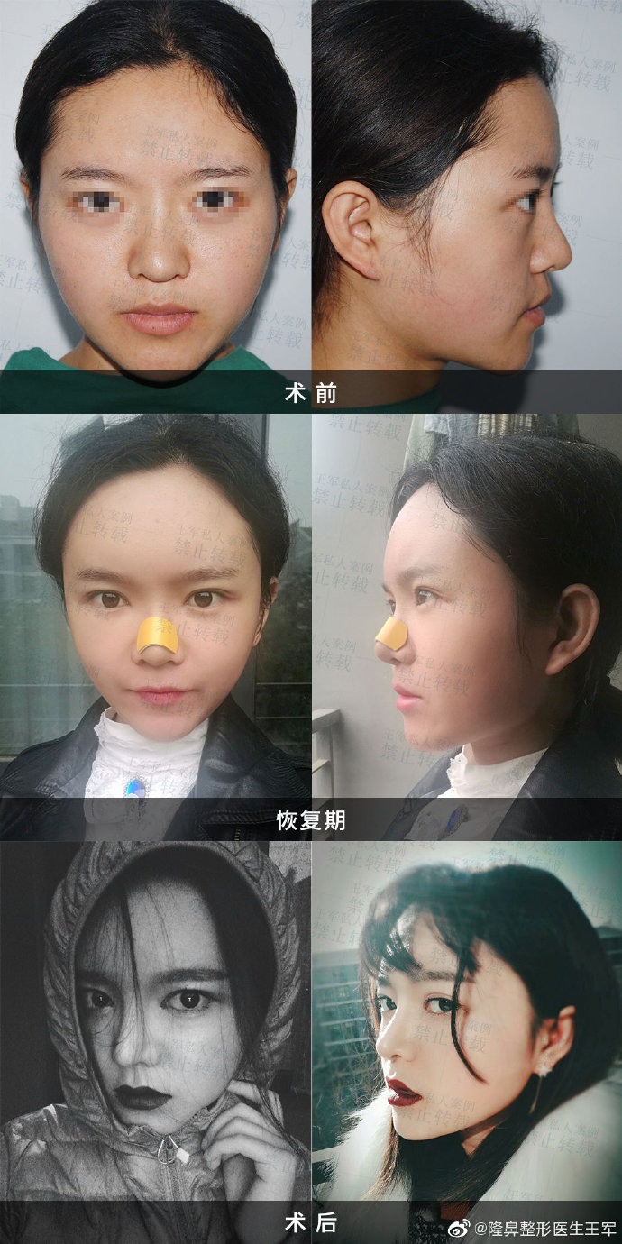 王軍鼻修復(fù)案例