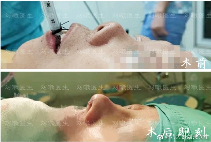 劉暾鼻修復(fù)案例