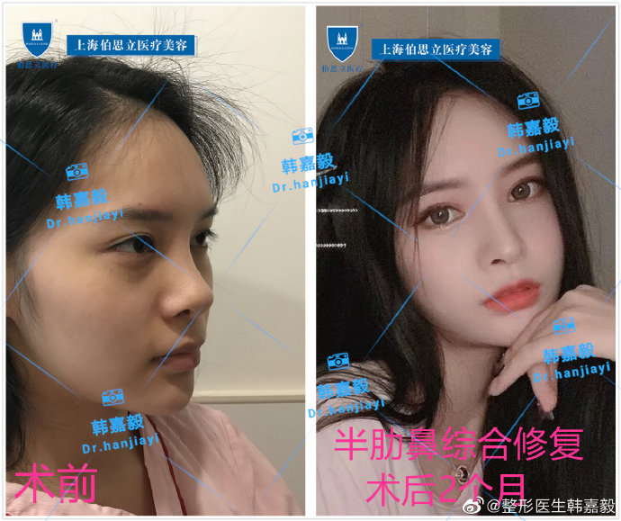 韓嘉毅鼻修復案例
