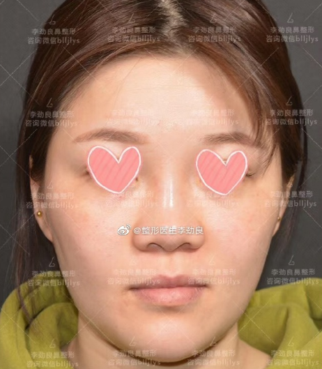李勁良鼻修復案例