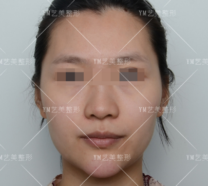 王東面部填充案例
