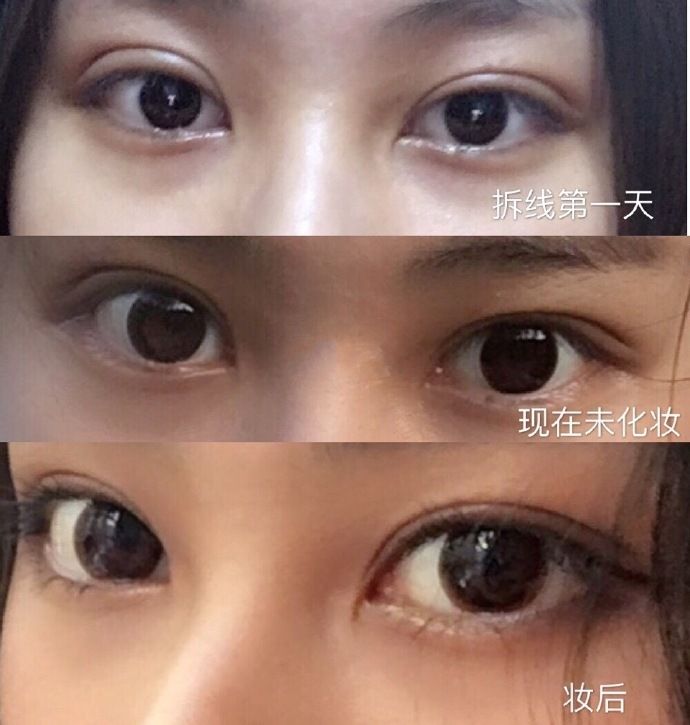 朱慧敏雙眼皮修復