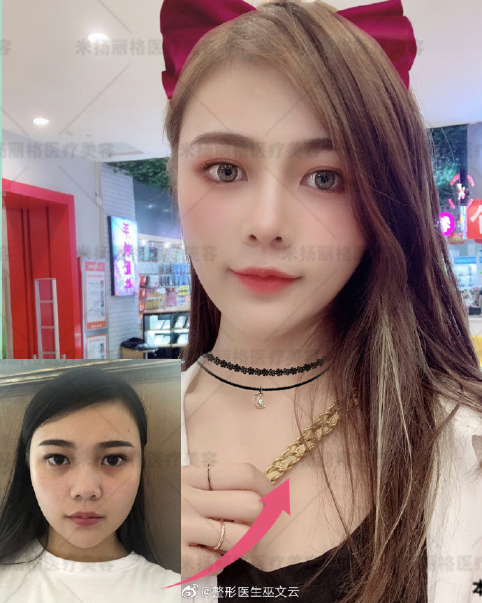 巫文云鼻修復案例