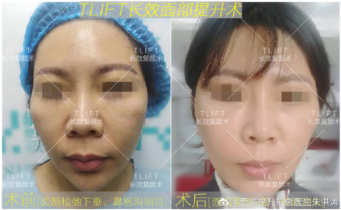 朱洪濤面部提升案例