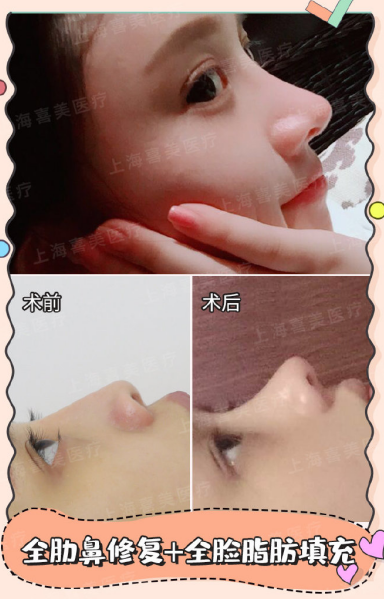 王會勇鼻修復案例