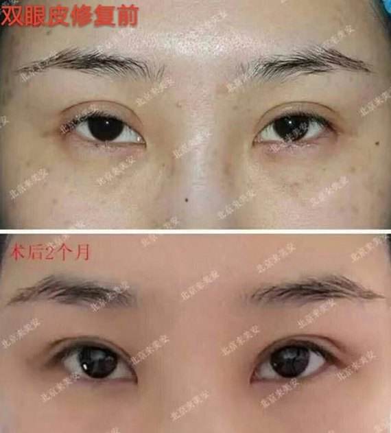 王振軍雙眼皮修復案例