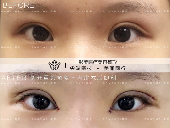 劉風(fēng)卓眼修復(fù)案例