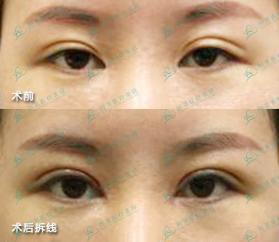 劉風(fēng)卓眼修復(fù)案例