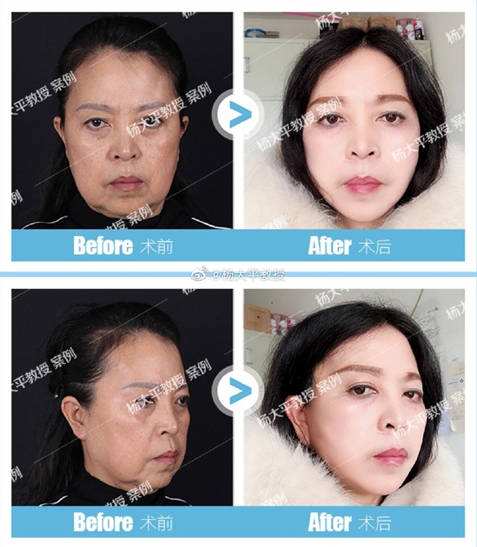 楊大平面部提升案例