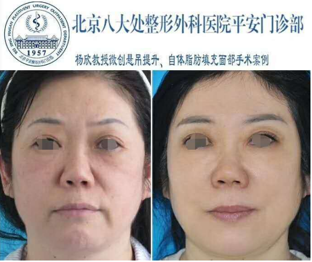 楊欣面部提升案例