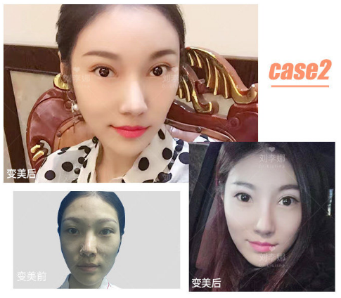 劉李娜面部填充案例