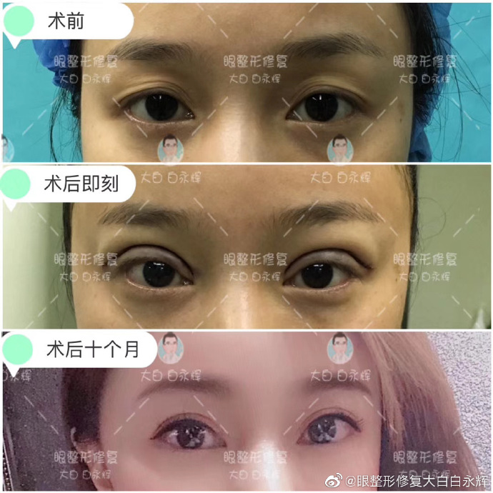 白永輝雙眼皮修復案例