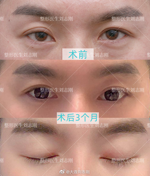 劉志剛眼修復案例