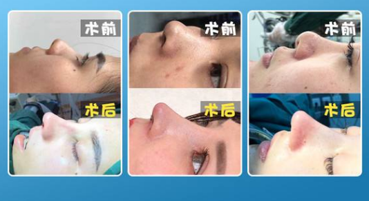 上海肋骨鼻做得比較好的醫(yī)生