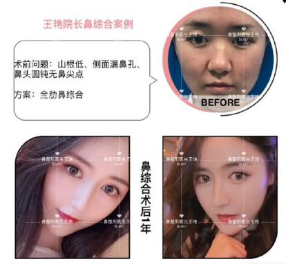 王艷肋骨鼻綜合案例
