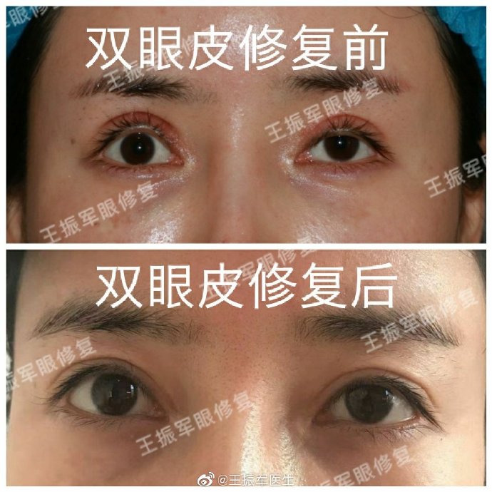王振軍眼修復案例