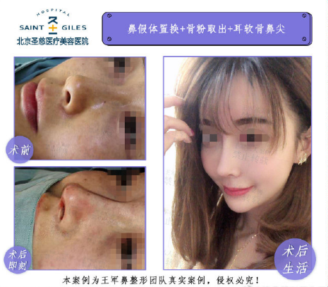 王軍隆鼻案例