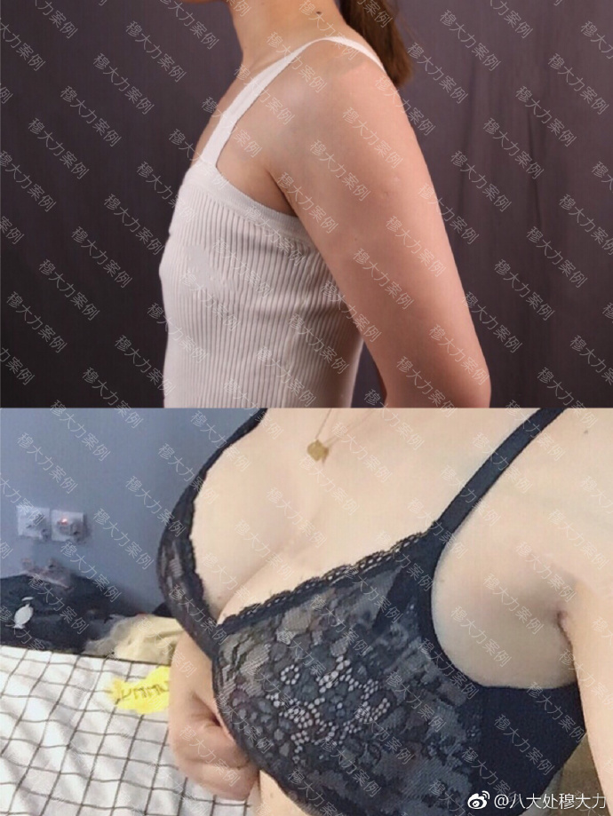 穆大力豐胸案例