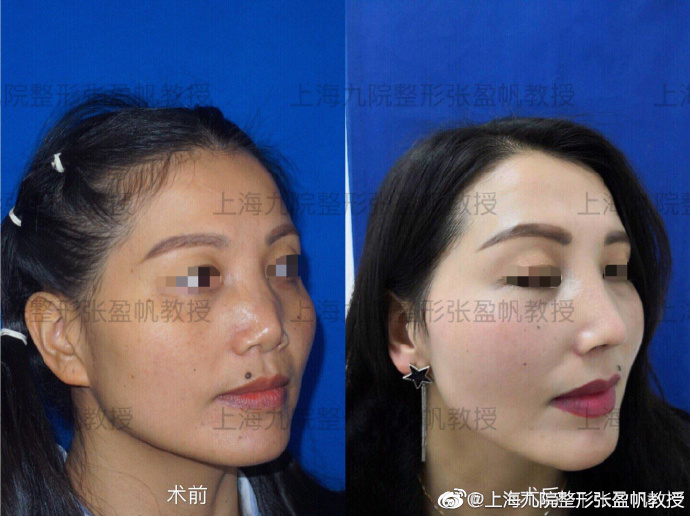 張盈帆鼻修復案例