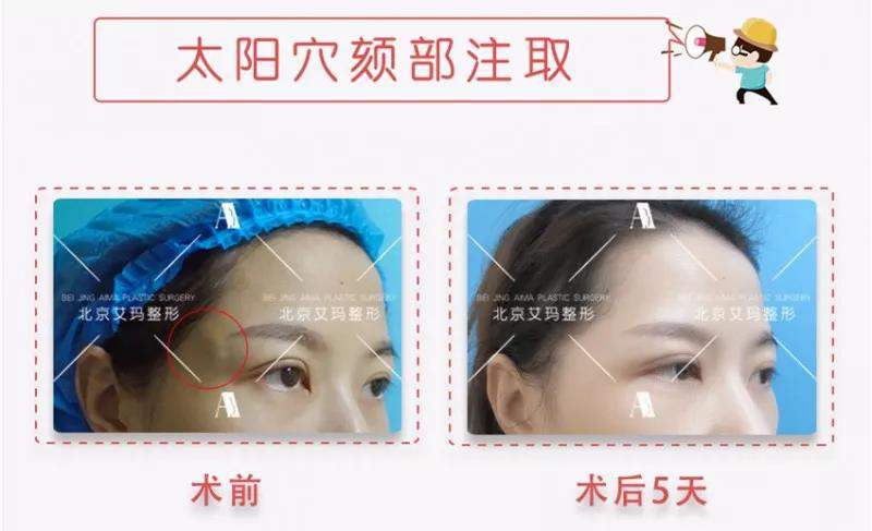 丁小邦奧美定取出案例