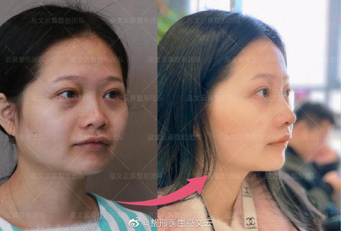 巫文云鼻修復(fù)案例