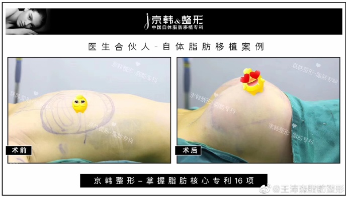 王沛森脂肪豐胸