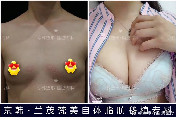 王沛森脂肪豐胸案例