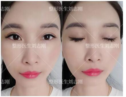 劉志剛眼修復案例