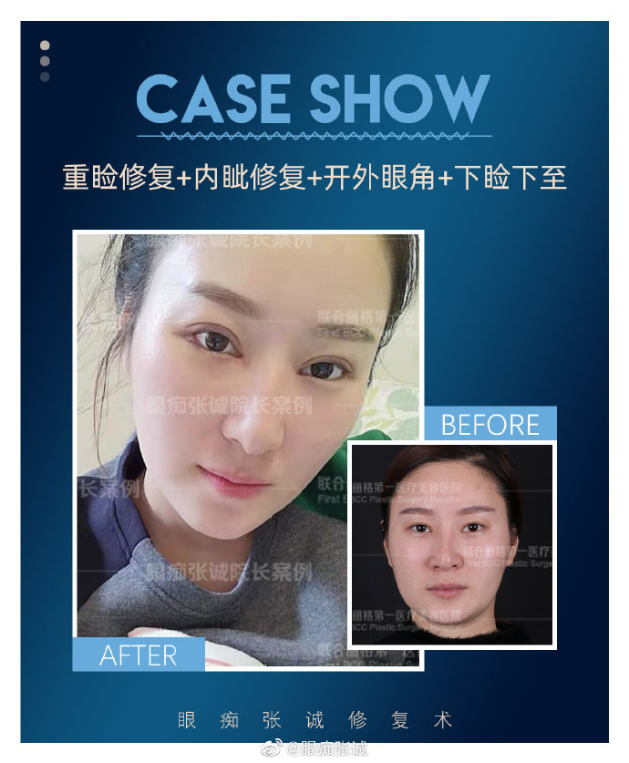 張誠眼修復案例