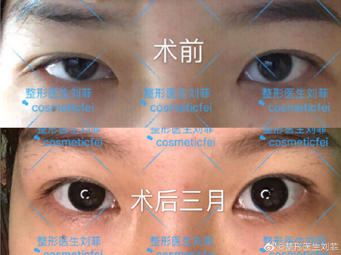 劉菲上瞼下垂矯正案例