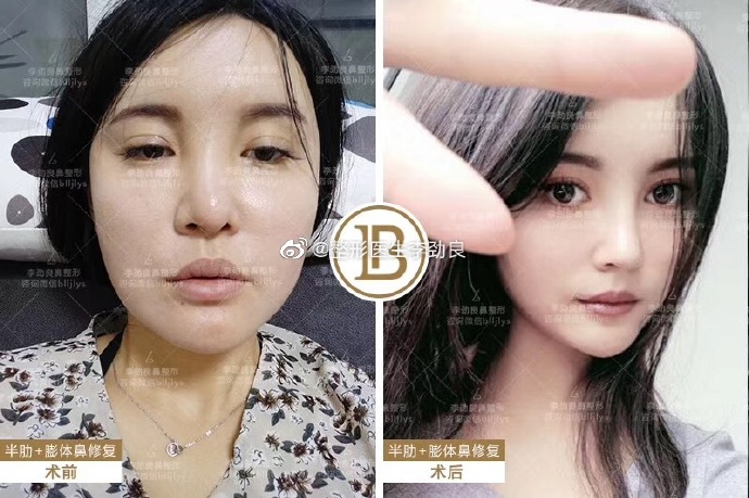 李勁良鼻修復案例