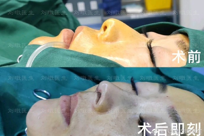 劉暾鼻綜合案例