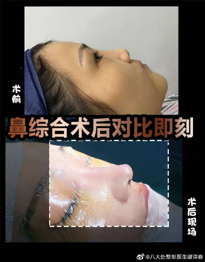 謝洋春鼻綜合案例