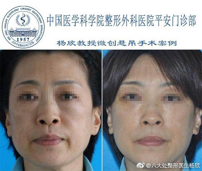 楊欣面部提升案例