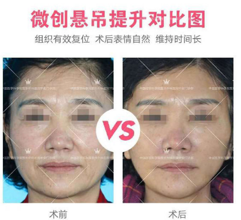 楊欣面部提升案例