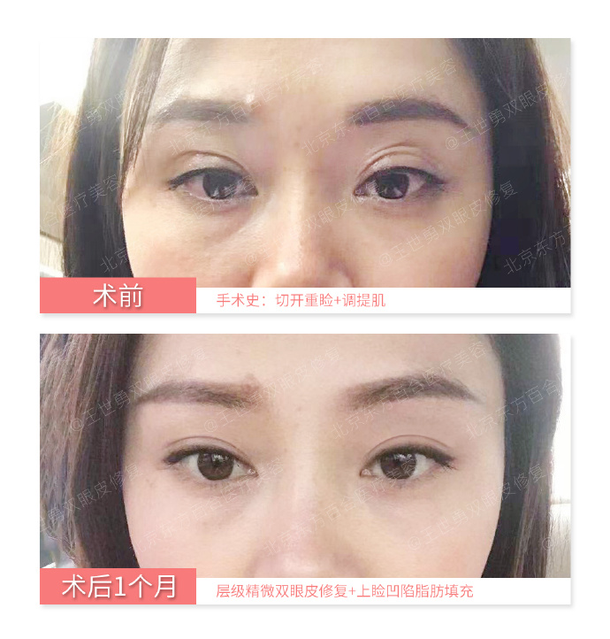 王世勇雙眼皮修復案例