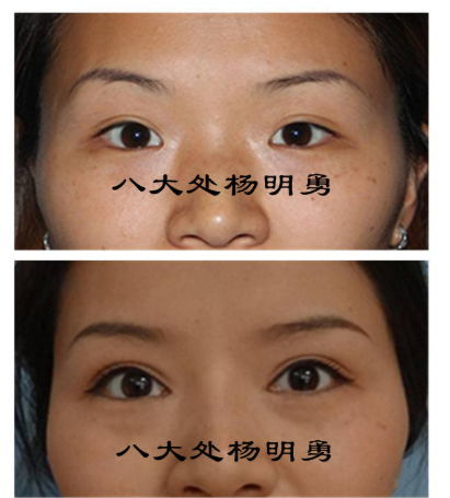 楊明勇雙眼皮案例