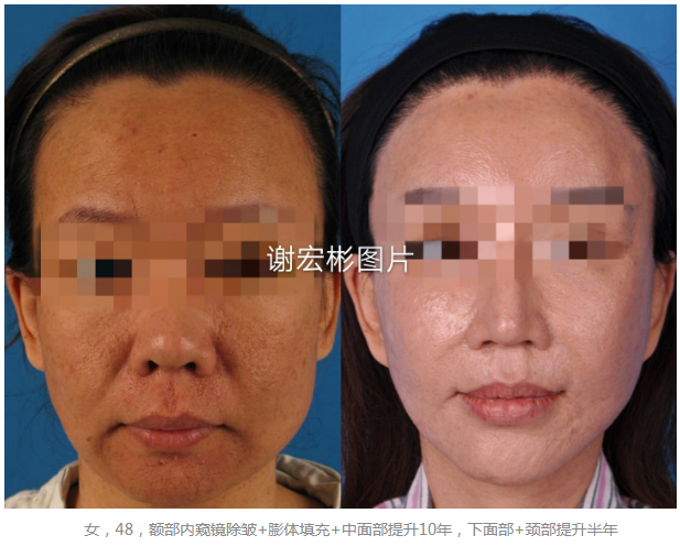 謝宏彬面部提升案例