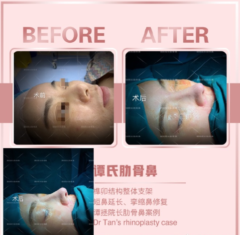 譚拯醫生怎么樣？譚拯做鼻子好不好？
