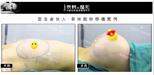 王沛森脂肪豐胸