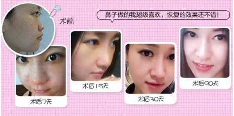 李愛林鼻綜合案例