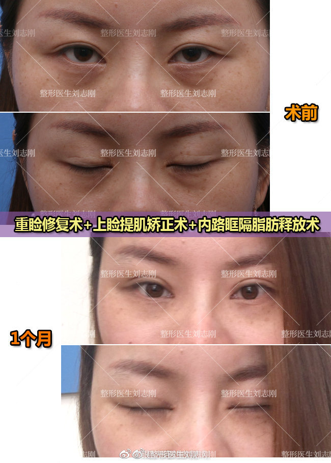劉志剛眼修復案例