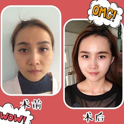孫瑋駿面部提升案例