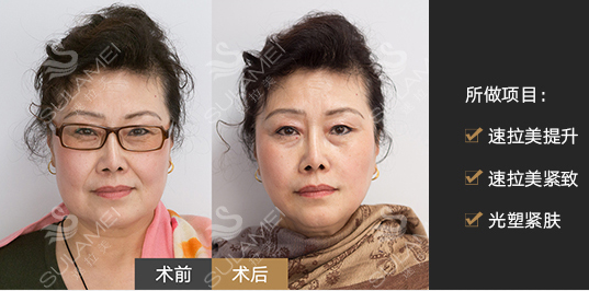 孫瑋駿面部提升案例