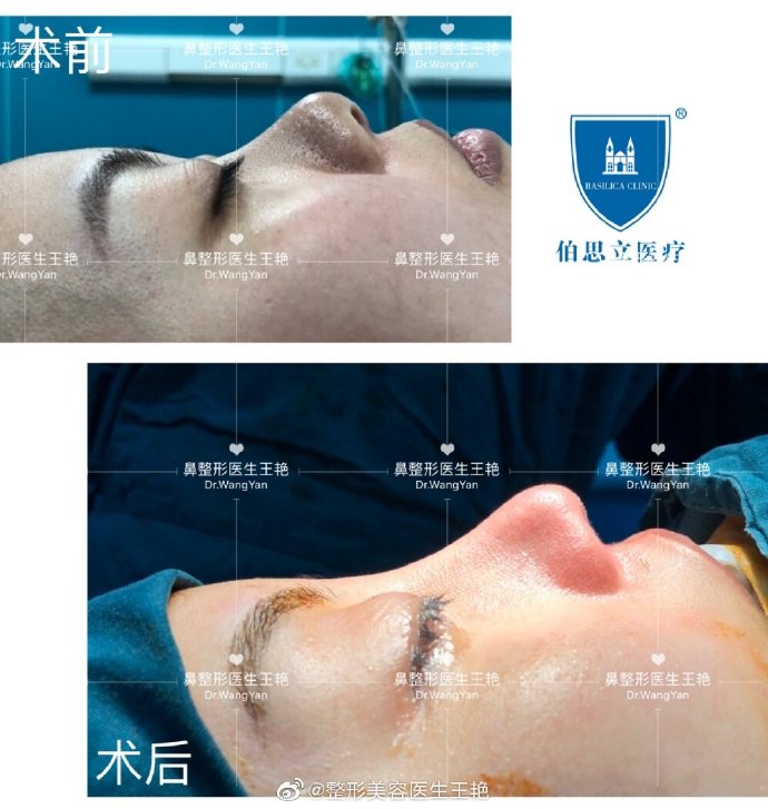 王艷鼻修復(fù)案例