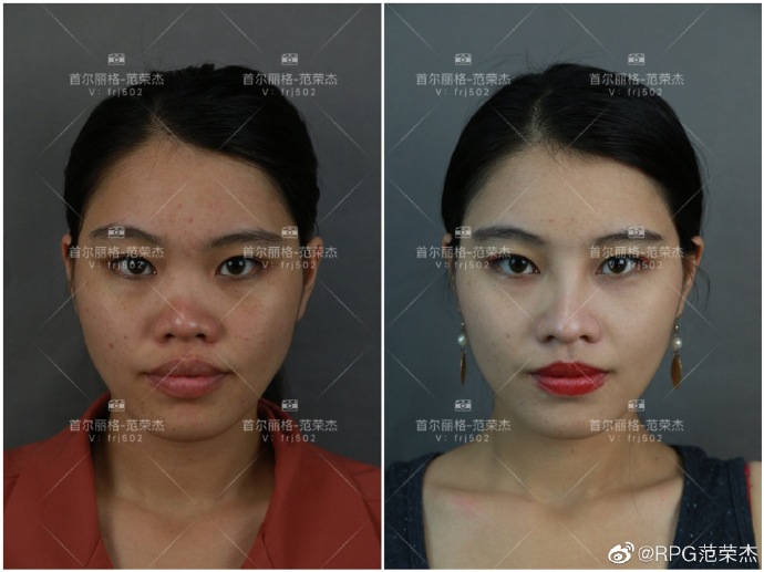范榮杰鼻案例